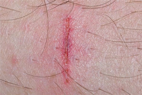 梦见舔伤口是什么意思