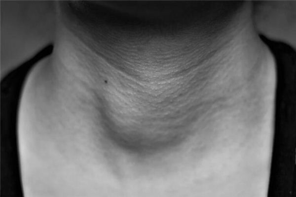 梦见肿瘤是什么意思 梦见肿瘤是什么意思