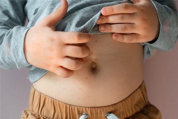 梦见生疥癣是什么意思 梦见生疥癣是什么意思